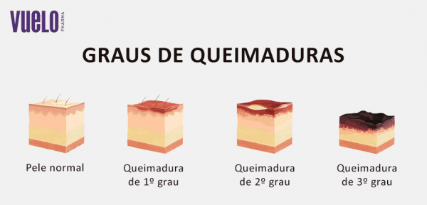 COMO TRATAR QUEIMADURAS?