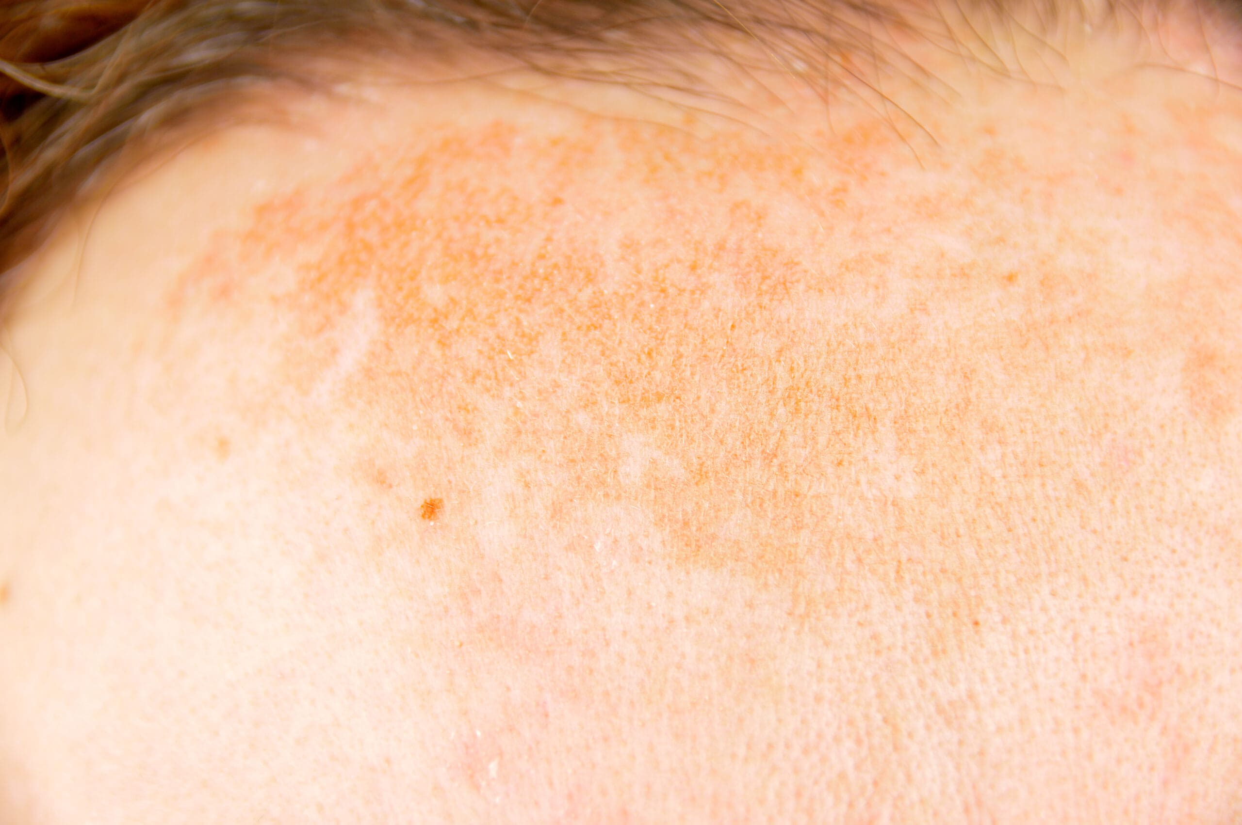 Diferenças entre Dermatose e Dermatite