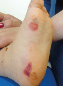 Doenças raras: Epidermólise Bolhosa Pele de criança com Epidermólise Bolhosa