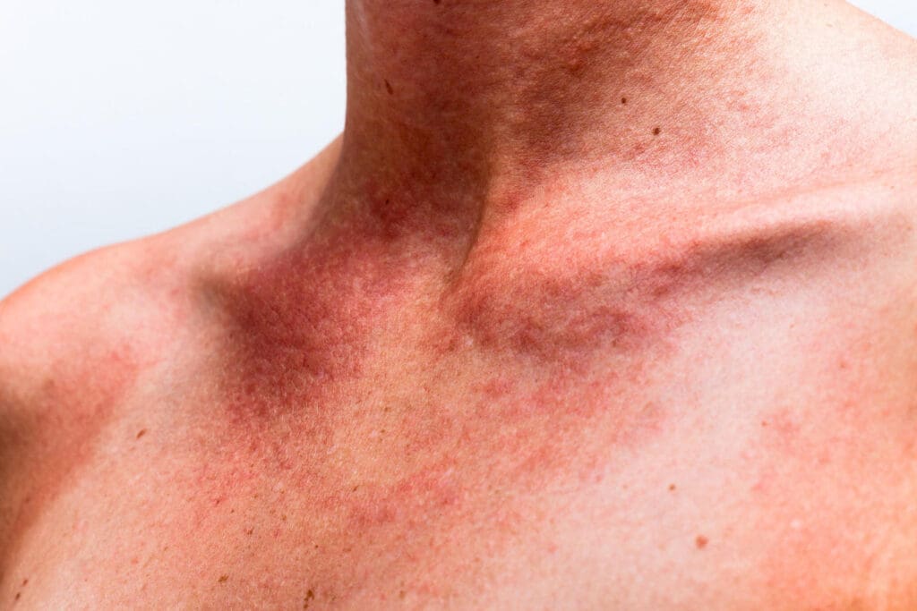Dermatomiosite: o que é, sintomas e tratamento
