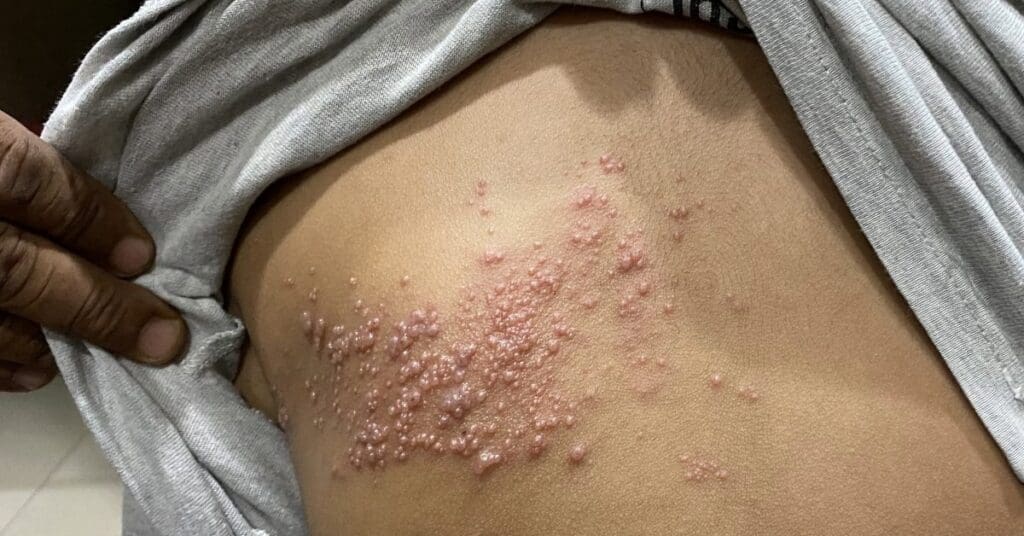 Herpes: o que é, como identificar e cuidar com acolhimento e informação