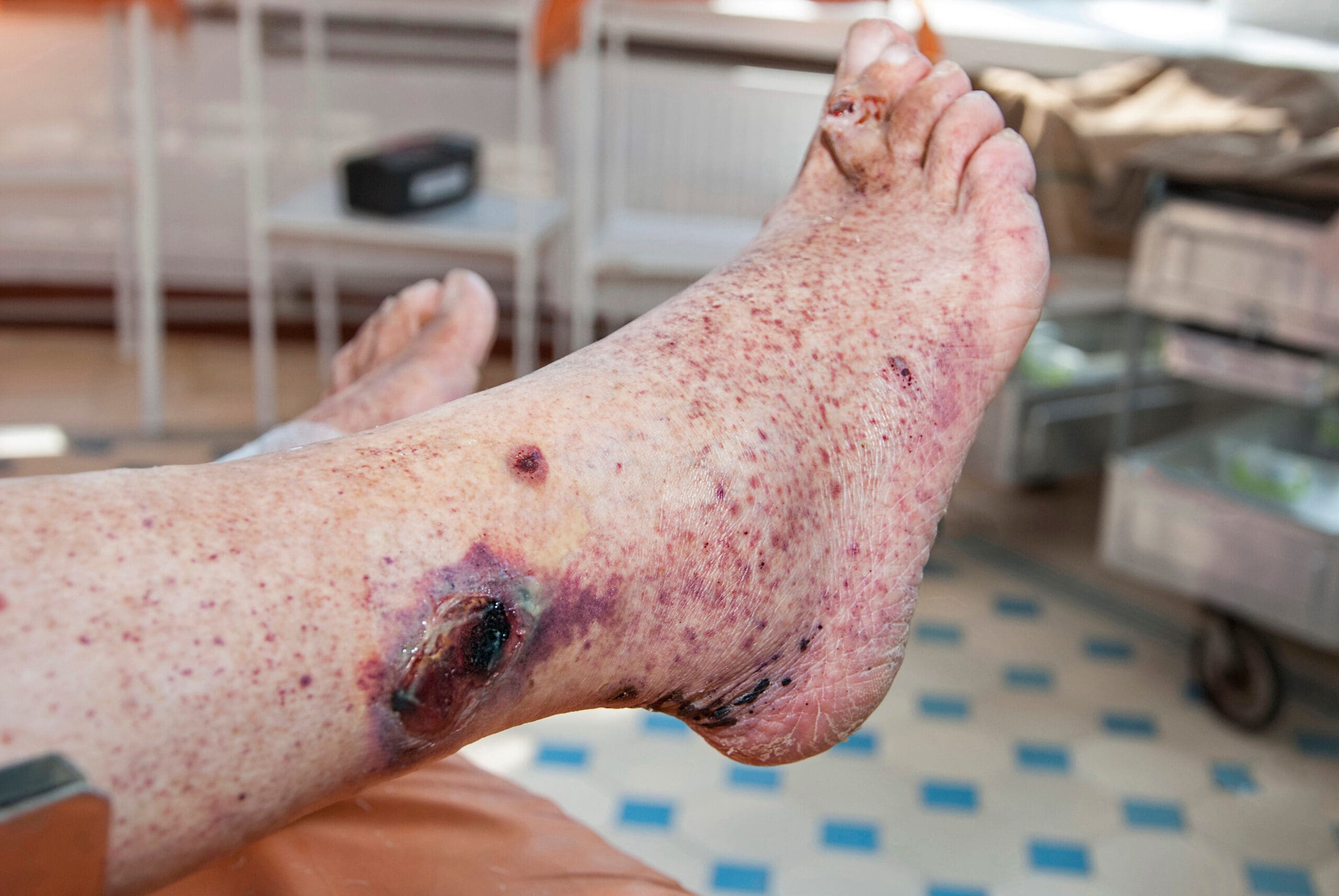 O que é vasculite cutânea? Conheça os sinais e como tratar